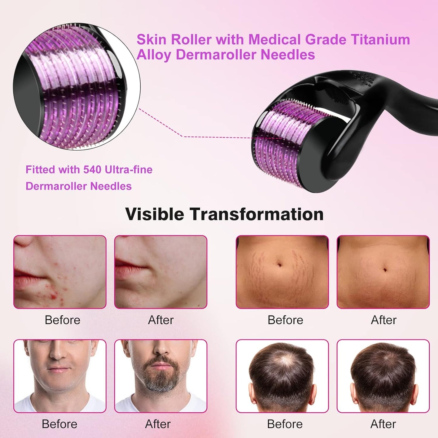 Classic Face Derma Rollers